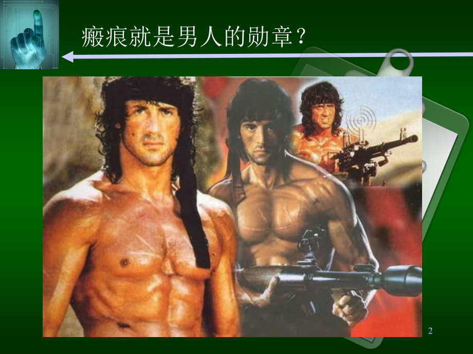 瘢痕的防治ppt课件.ppt_第2页