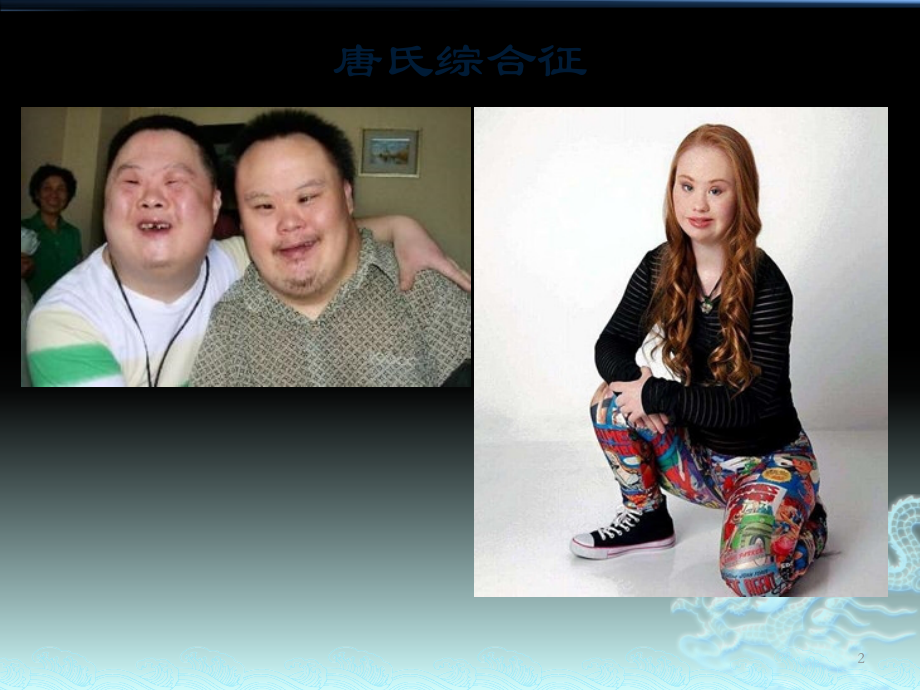 唐氏综合征-ppt课件.pptx_第2页