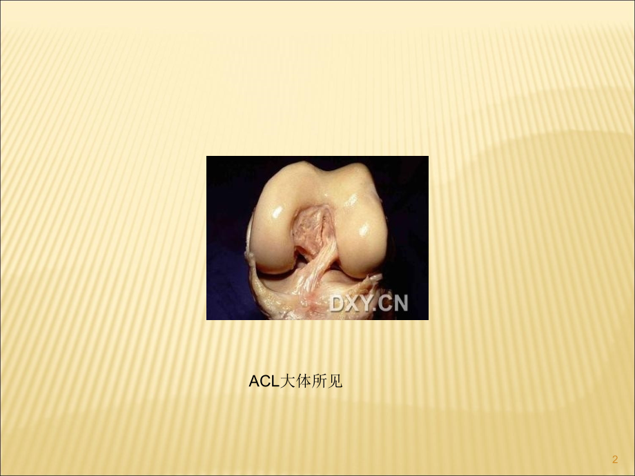 ACL损伤的治疗.ppt_第2页
