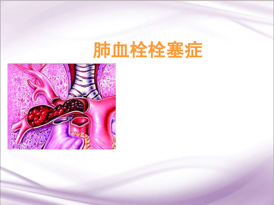 肺栓塞内科讲课ppt课件.ppt_第1页