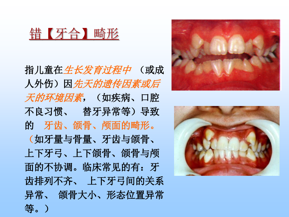 错颌畸形的病因.ppt_第2页