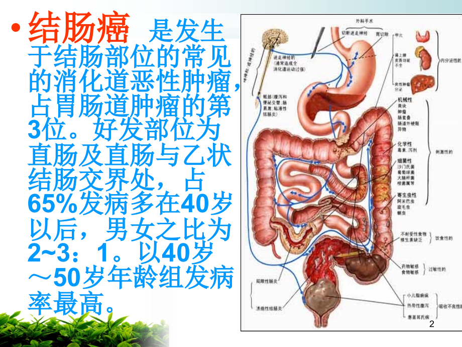 结肠癌护理ppt课件.ppt_第2页