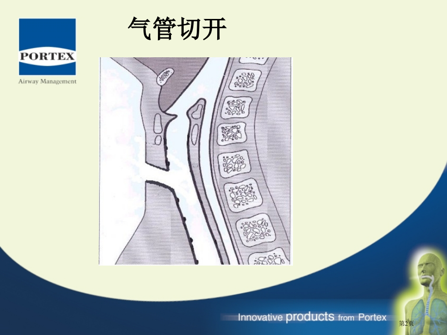 气管切开套管.pptx_第2页