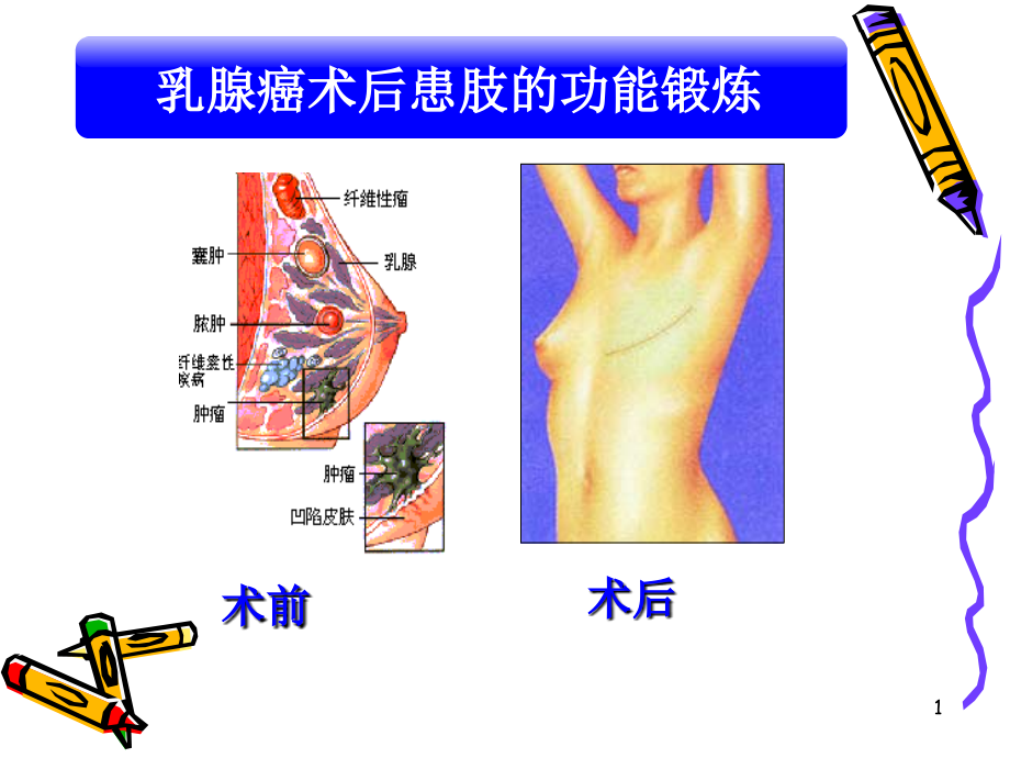 乳腺癌术后的功能锻炼ppt课件.ppt_第1页