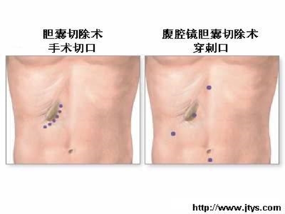 腹腔镜术前术后的护理11.ppt_第2页