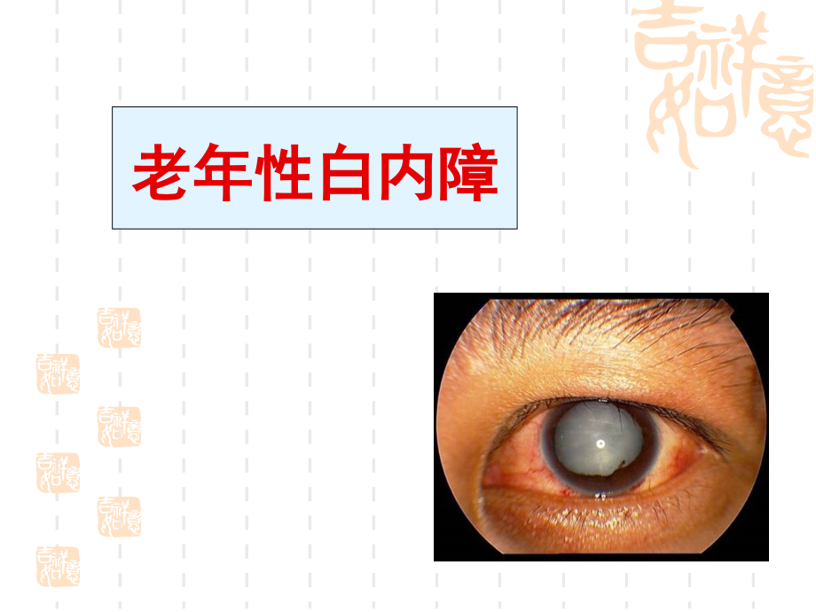 老年性白内障.ppt_第1页