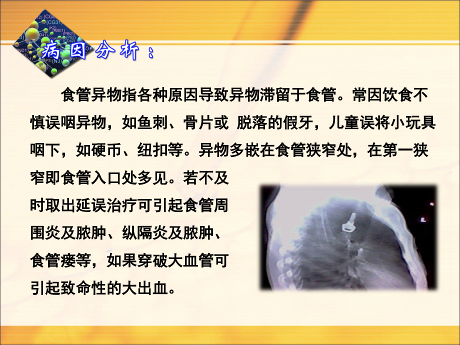 食道异物护理课件.ppt_第2页