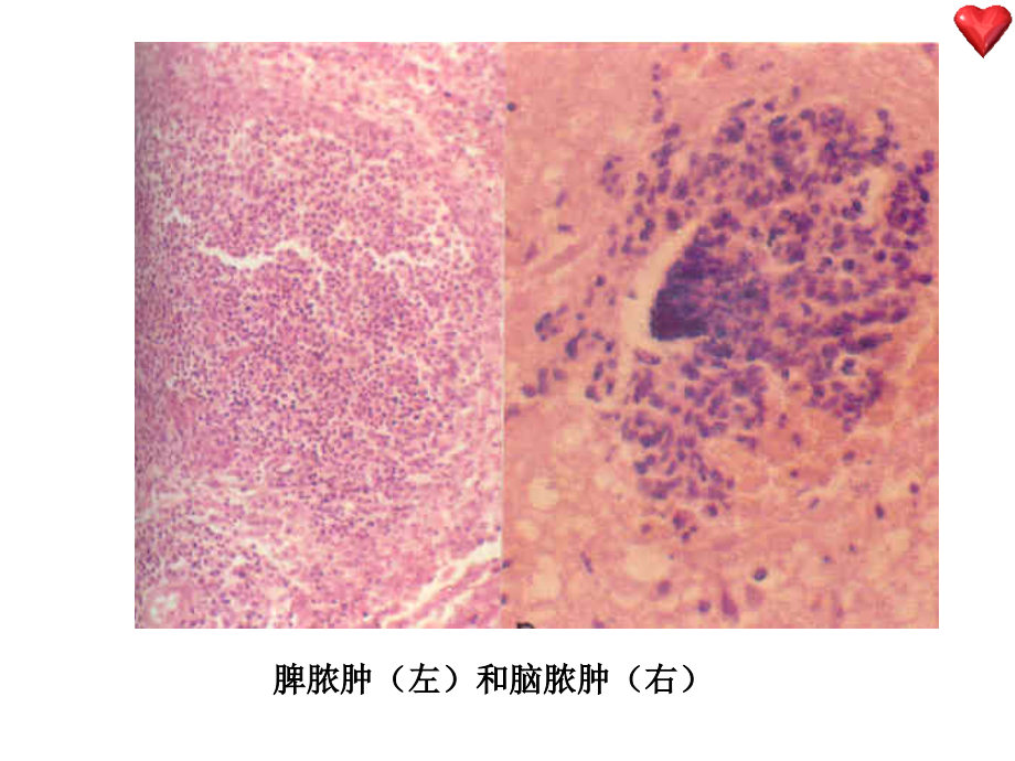 化脓性炎.ppt_第2页