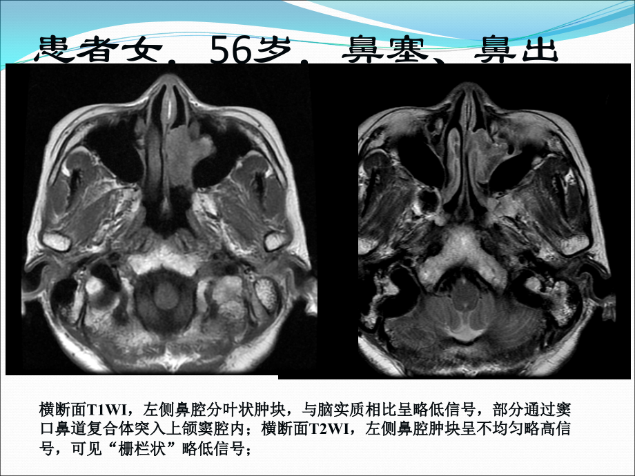 鼻腔及鼻窦内翻性乳头状瘤.ppt_第2页