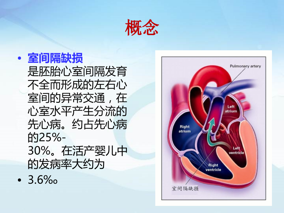 室间隔缺损.ppt_第2页