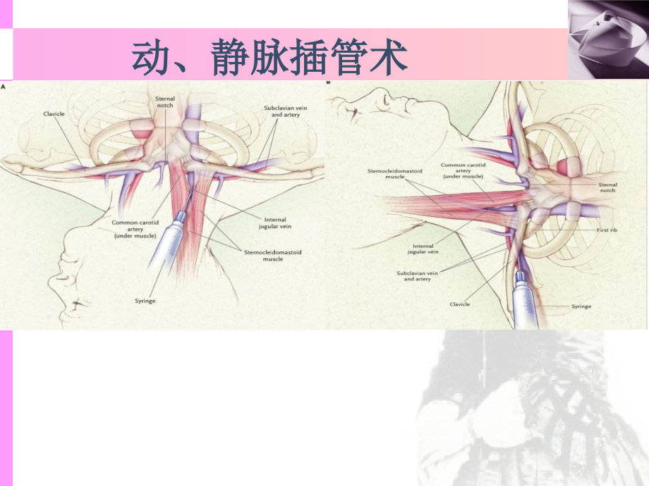 动静脉插管术.ppt_第1页