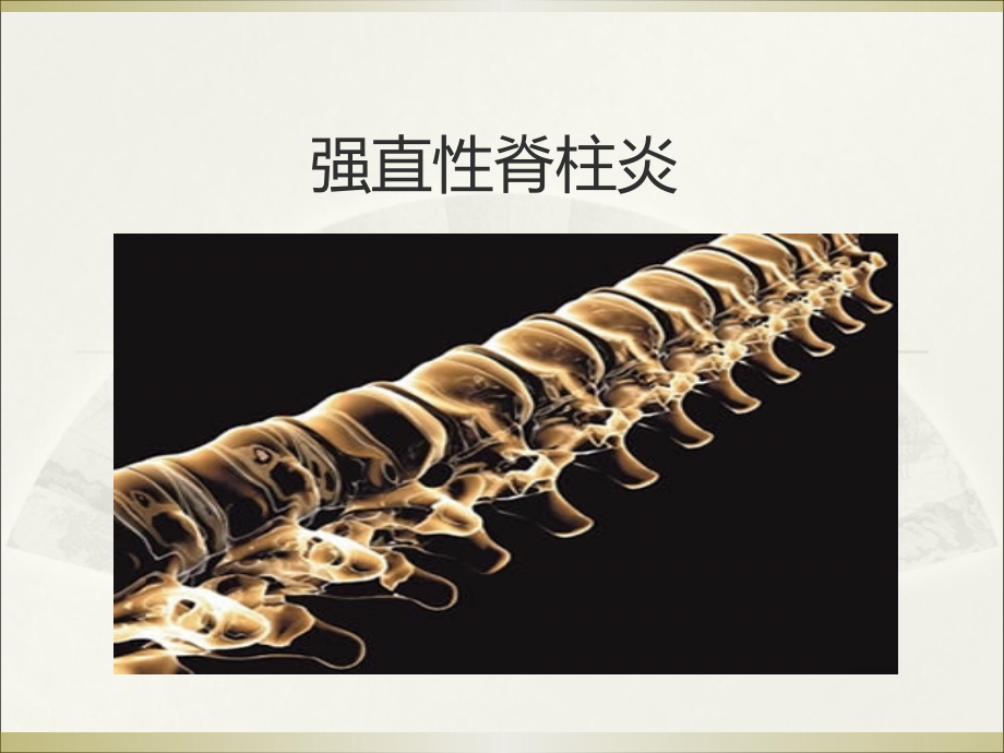 强直性脊柱炎(岩).ppt_第2页