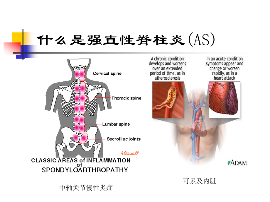 强直性脊柱炎驼背.ppt_第2页