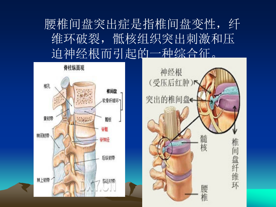 腰椎间盘突出症术前术后指导..ppt_第2页