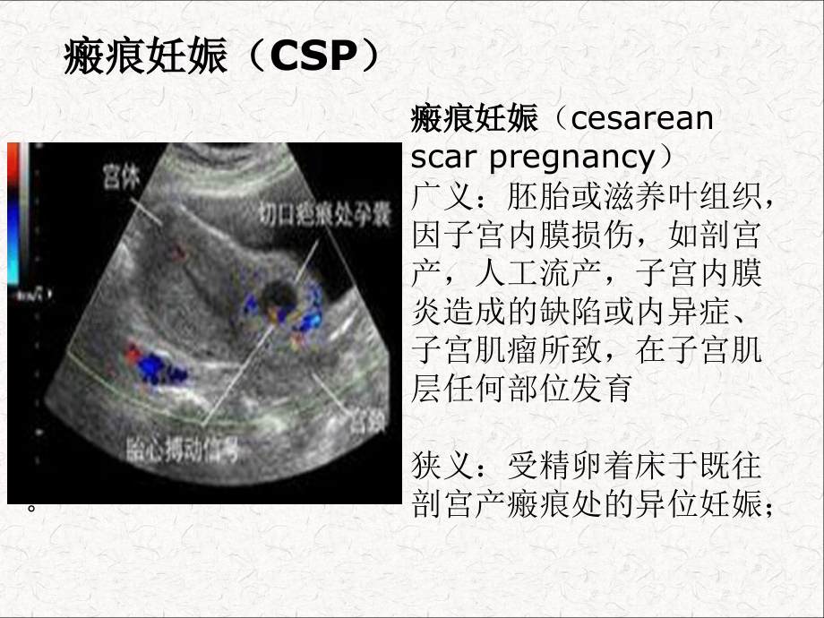 子宫瘢痕妊娠...ppt_第2页