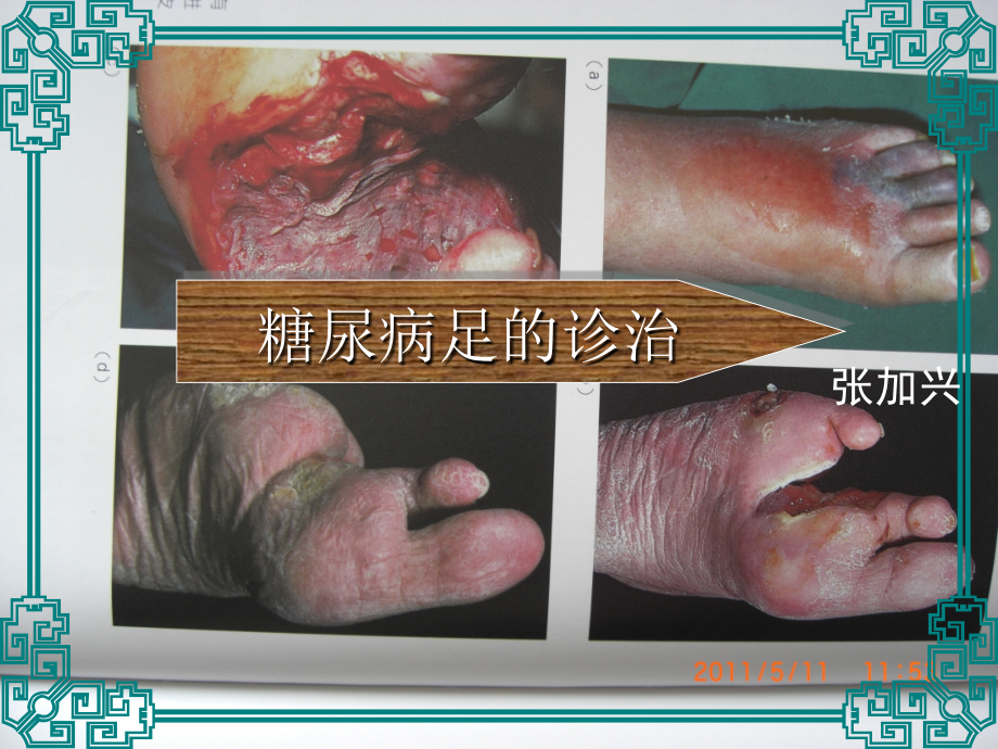 糖尿病足的诊治.ppt_第1页