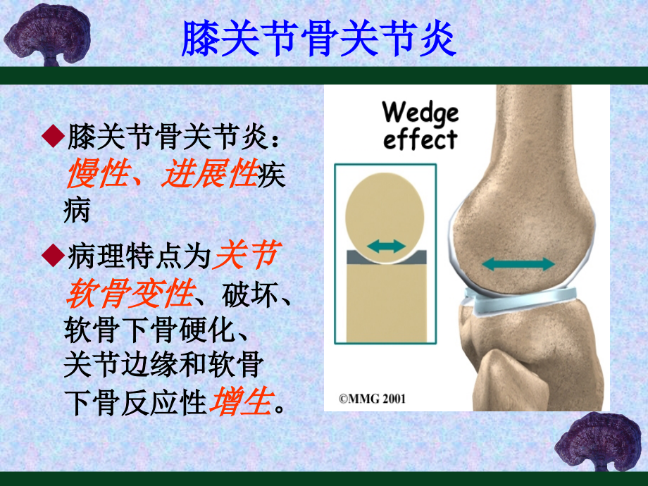 膝骨关节炎的防治..ppt_第2页