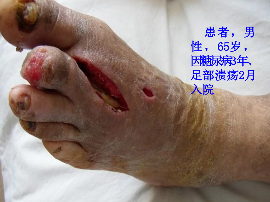 糖尿病足进展(图片).ppt_第2页