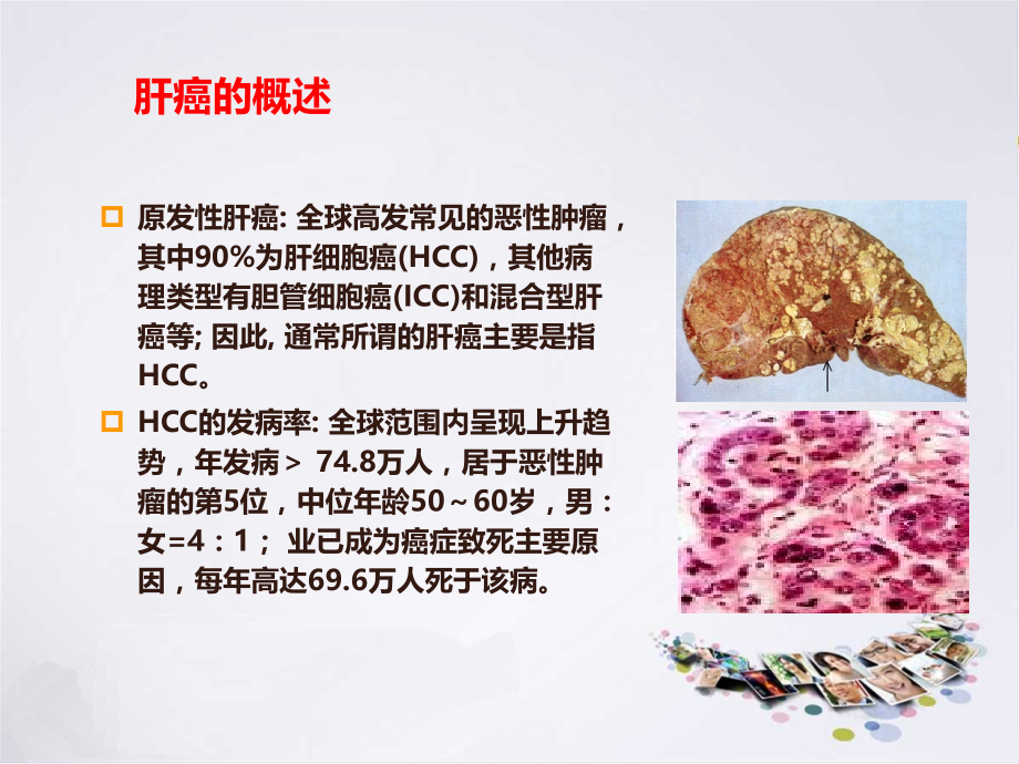 晚期肝癌.ppt_第2页