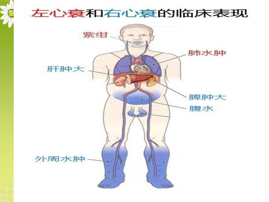 扩张性心肌病第二部分.ppt_第2页