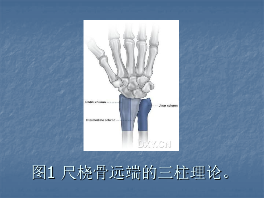 桡骨远端骨折应用锁定钢板手术方法.ppt_第2页