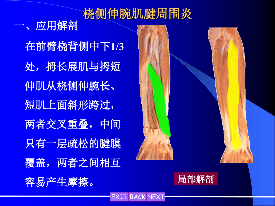 桡侧伸腕肌腱周围炎.ppt_第1页