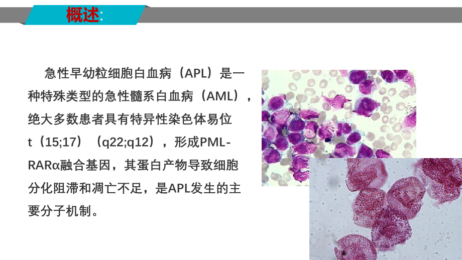 中国2018版急性早幼粒细胞白血病诊疗指南.pptx_第2页
