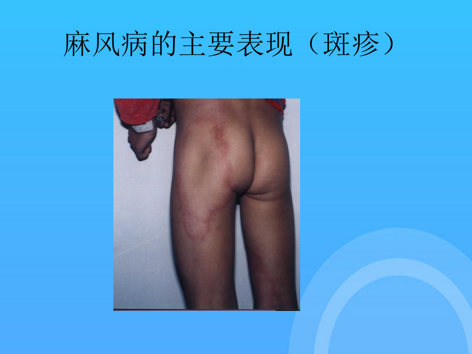 麻风病的临床表现和诊断.ppt_第2页