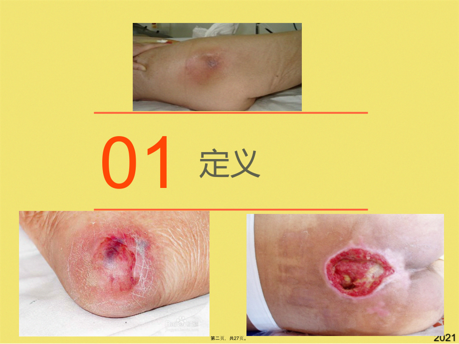 压疮的预防及护理健康教育.pptx_第2页