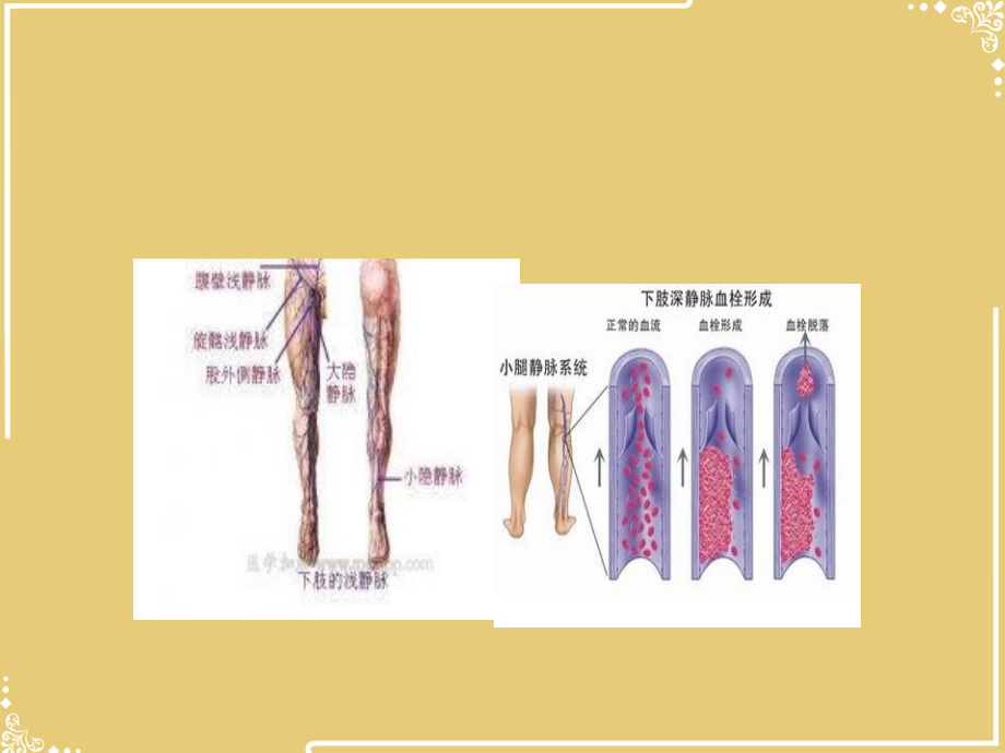 深静脉血栓的形成及预防月文档.ppt_第2页