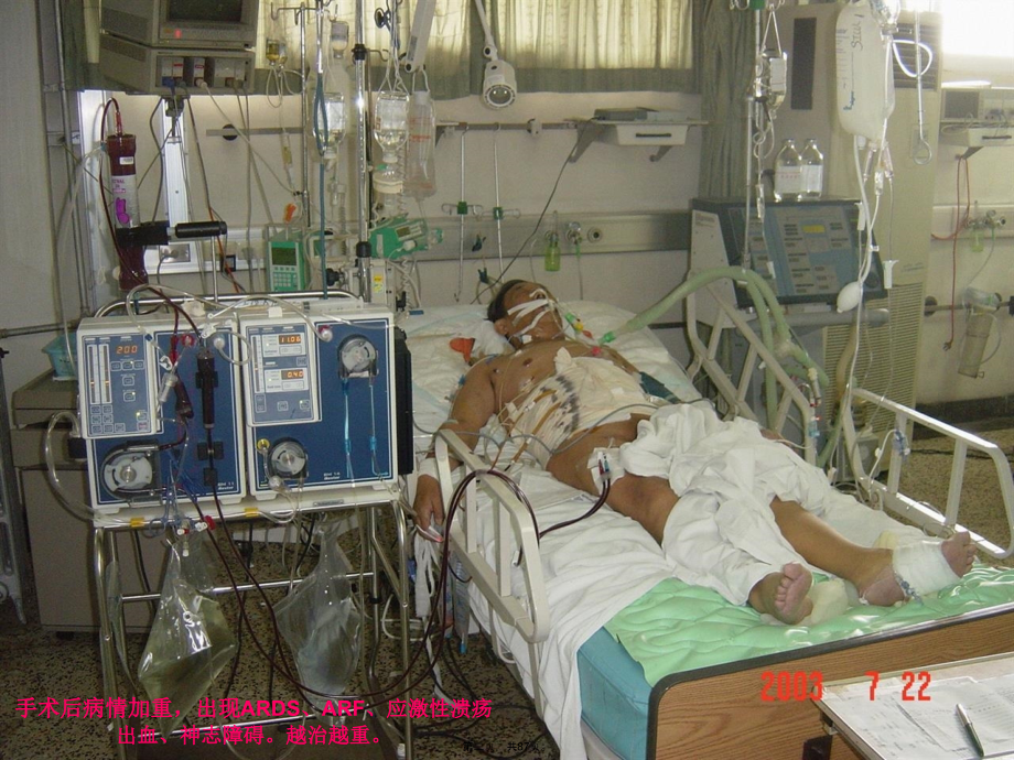 多器官功能障碍综合症讲义.pptx_第2页