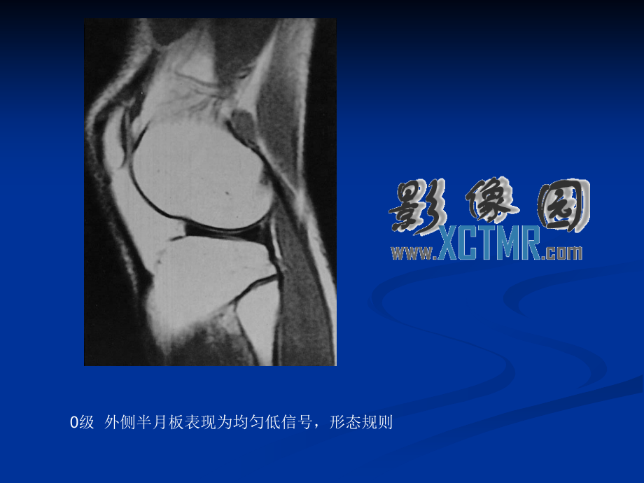 膝关节半月板病变mri病例图片及分析.ppt_第1页