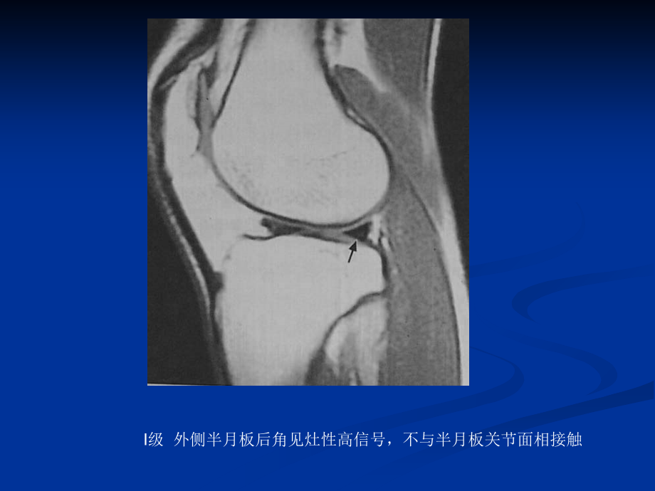 膝关节半月板病变mri病例图片及分析.ppt_第2页