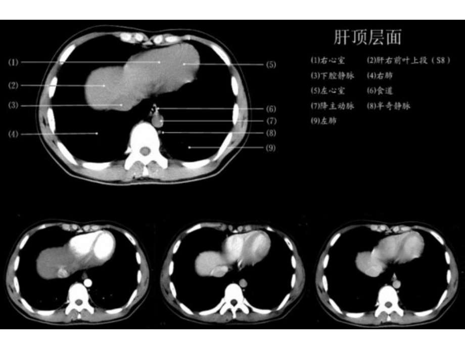 上腹部CT各个层面.ppt_第1页