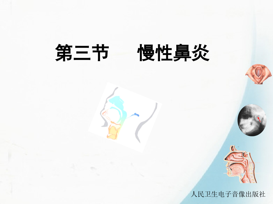 第三节 慢性鼻炎.ppt_第1页