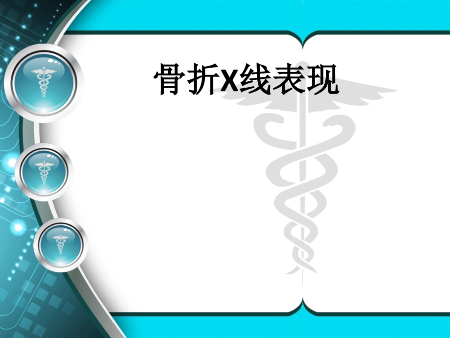 骨折x线11.ppt_第1页