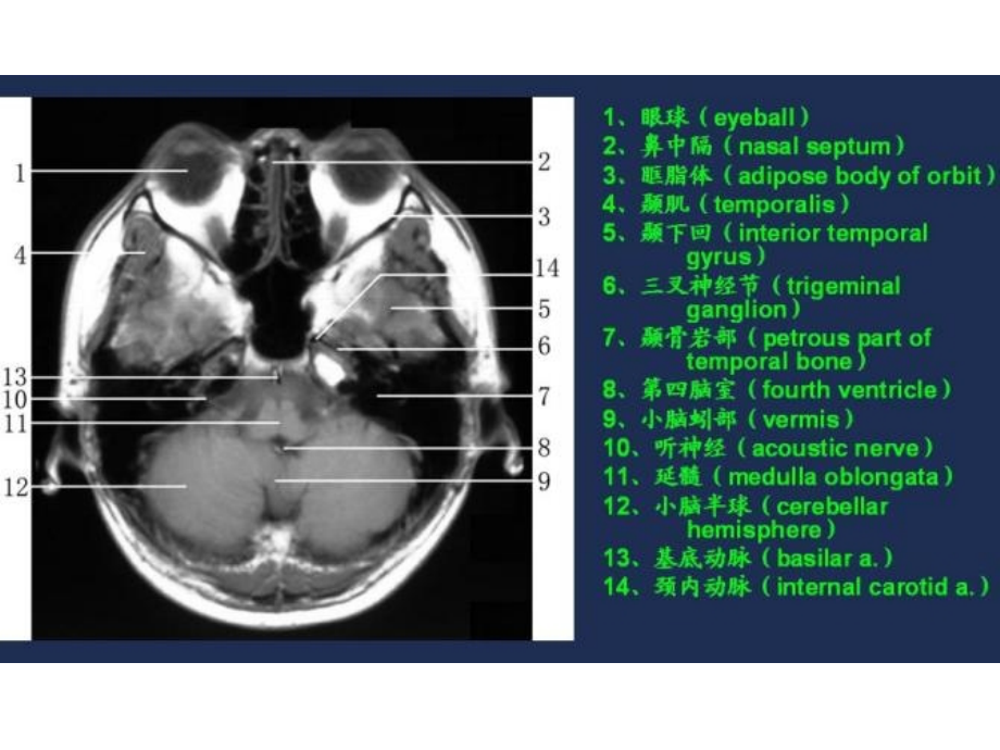 MRI常用解剖.ppt_第1页