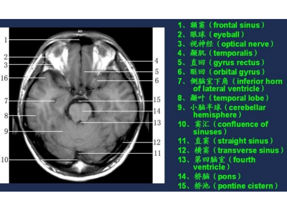 MRI常用解剖.ppt_第2页