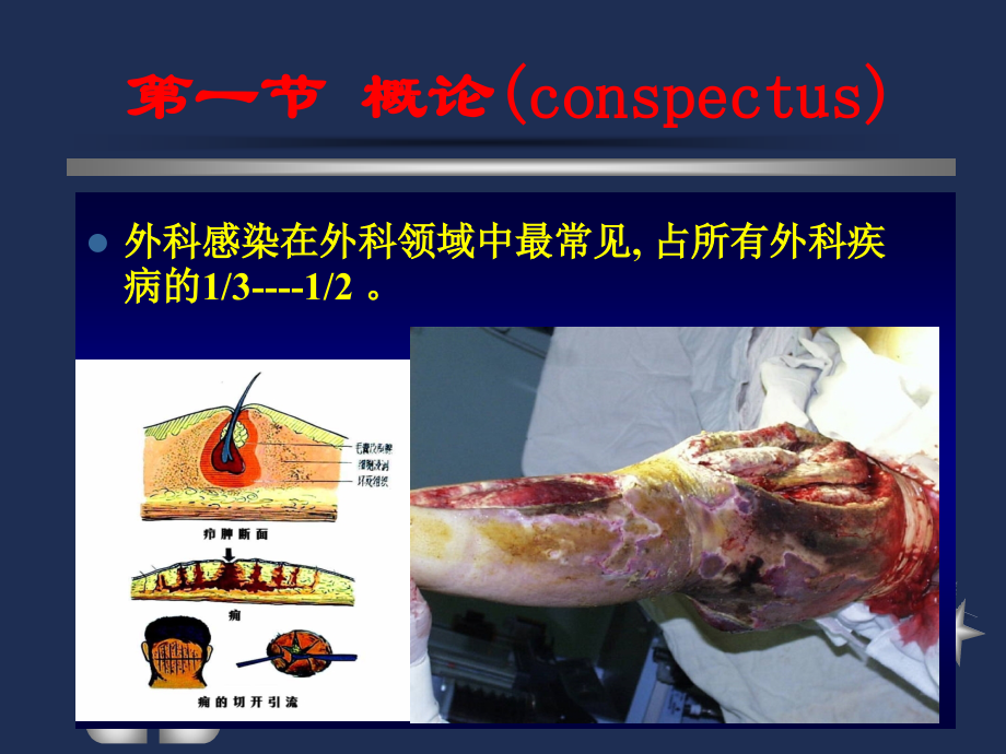 外科感染患者护理1.ppt_第2页
