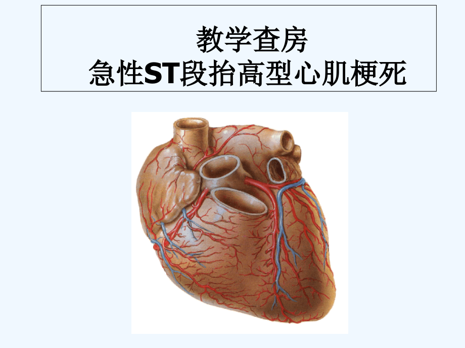 教学查房(急性心肌梗死).ppt_第1页