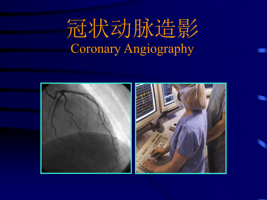 冠脉造影解读修改版课件.ppt_第2页