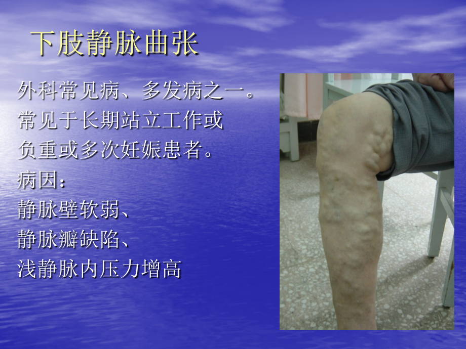 腔内激光治疗下肢静脉曲张--医学课件.ppt_第2页