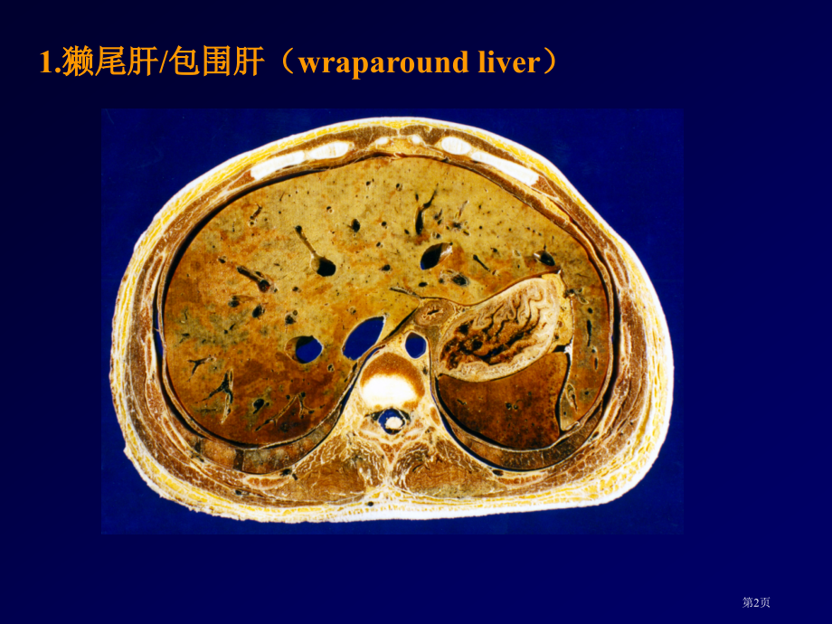 肝脾常见变异.pptx_第2页