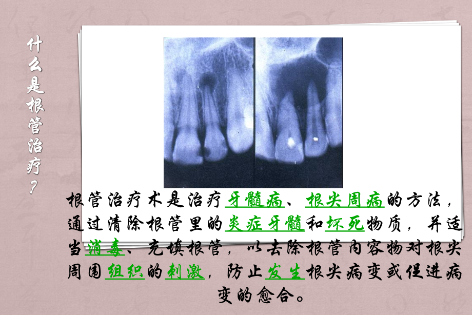 根管治疗护理配合.pptx_第2页