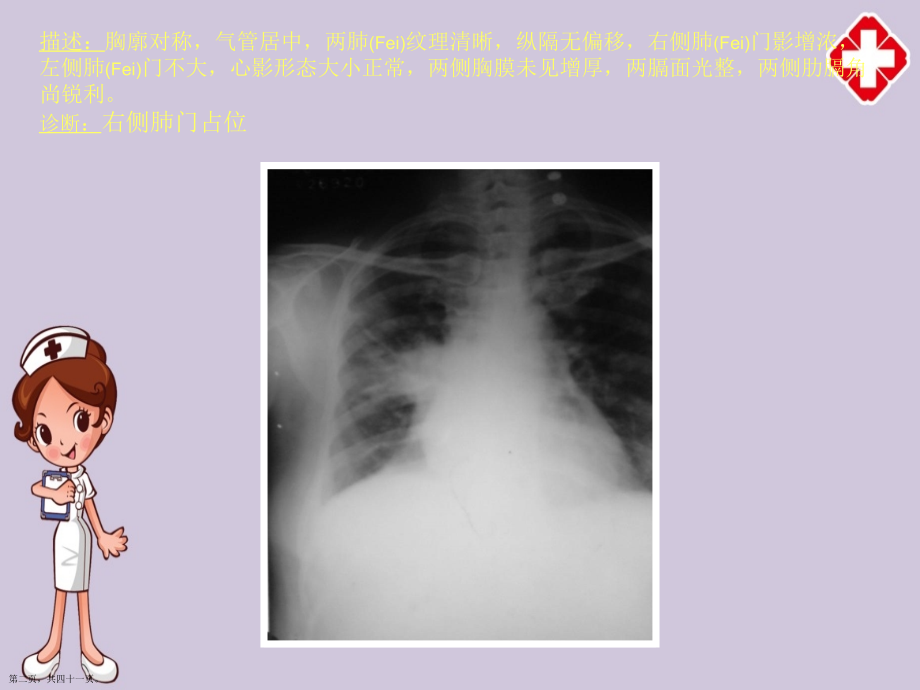 常见四十张X片读片及诊断及治疗临床病例培训学习.pptx_第2页