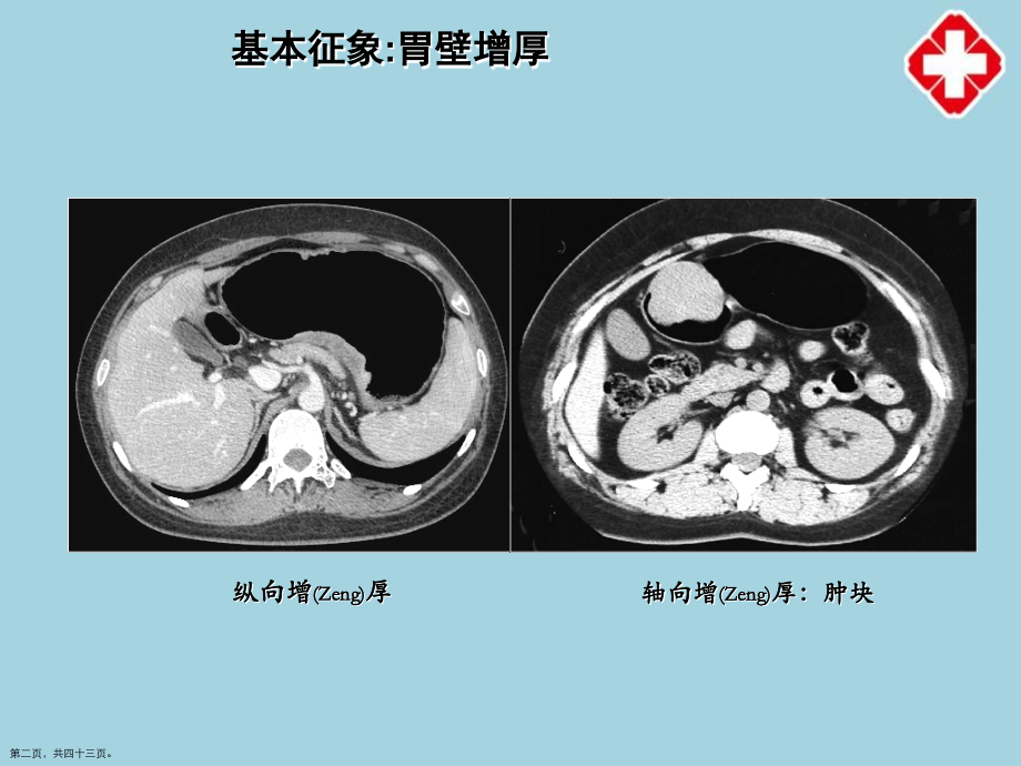 胃癌影像的诊断及治疗主题.pptx_第2页
