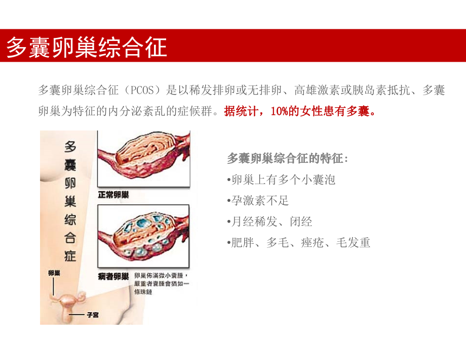 多囊卵巢综合征常见问题解答.pptx_第1页