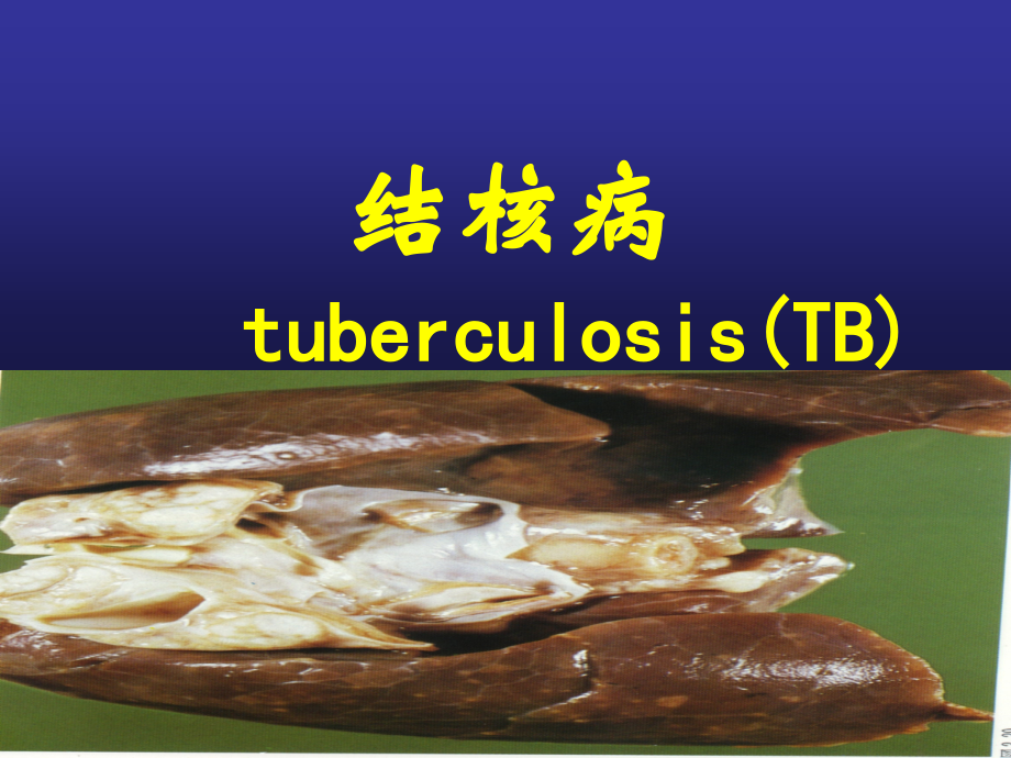 结核病(new-j).ppt_第1页