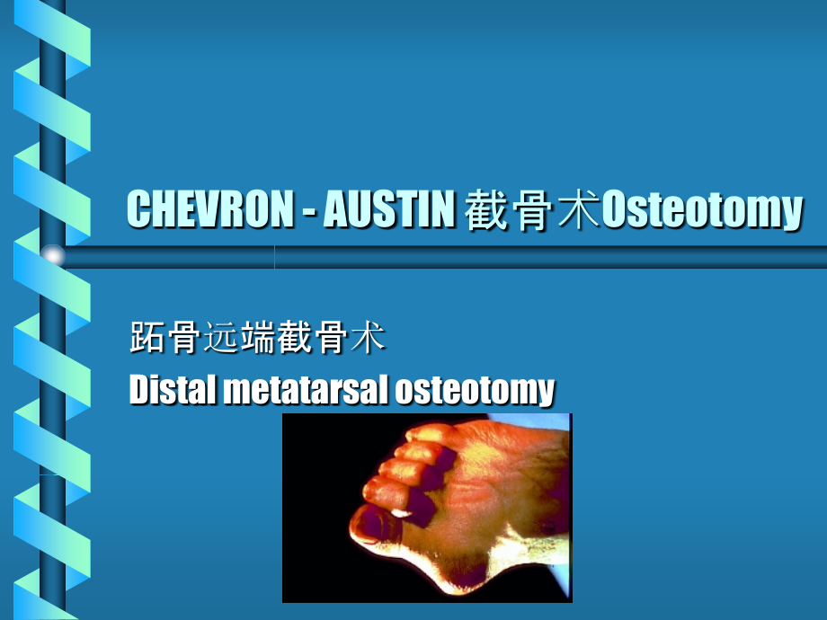 CHEVRON - AUSTIN 踇外翻跖骨截骨术1.ppt_第1页