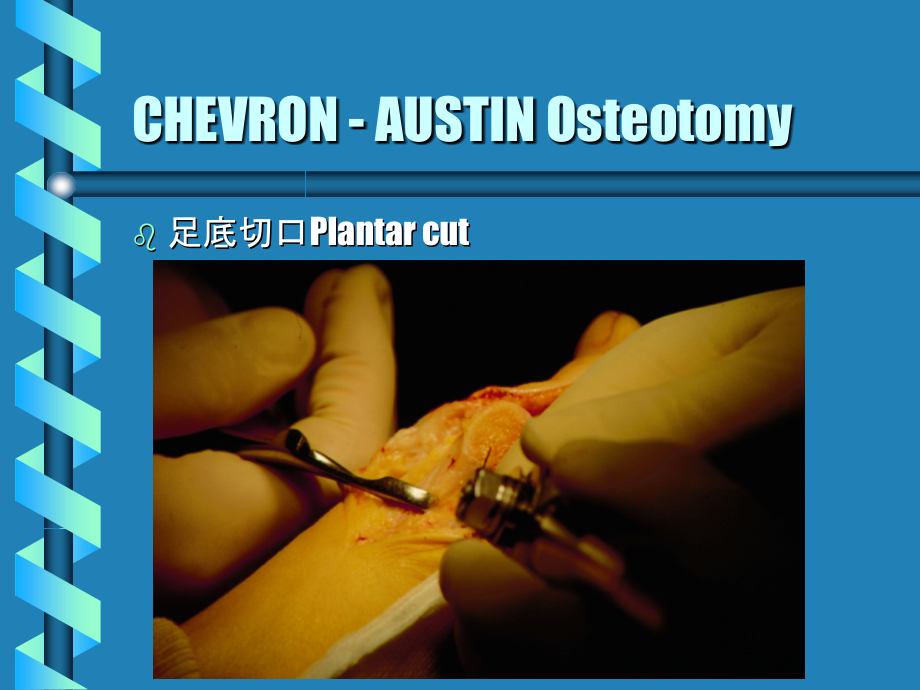 CHEVRON - AUSTIN 踇外翻跖骨截骨术1.ppt_第2页